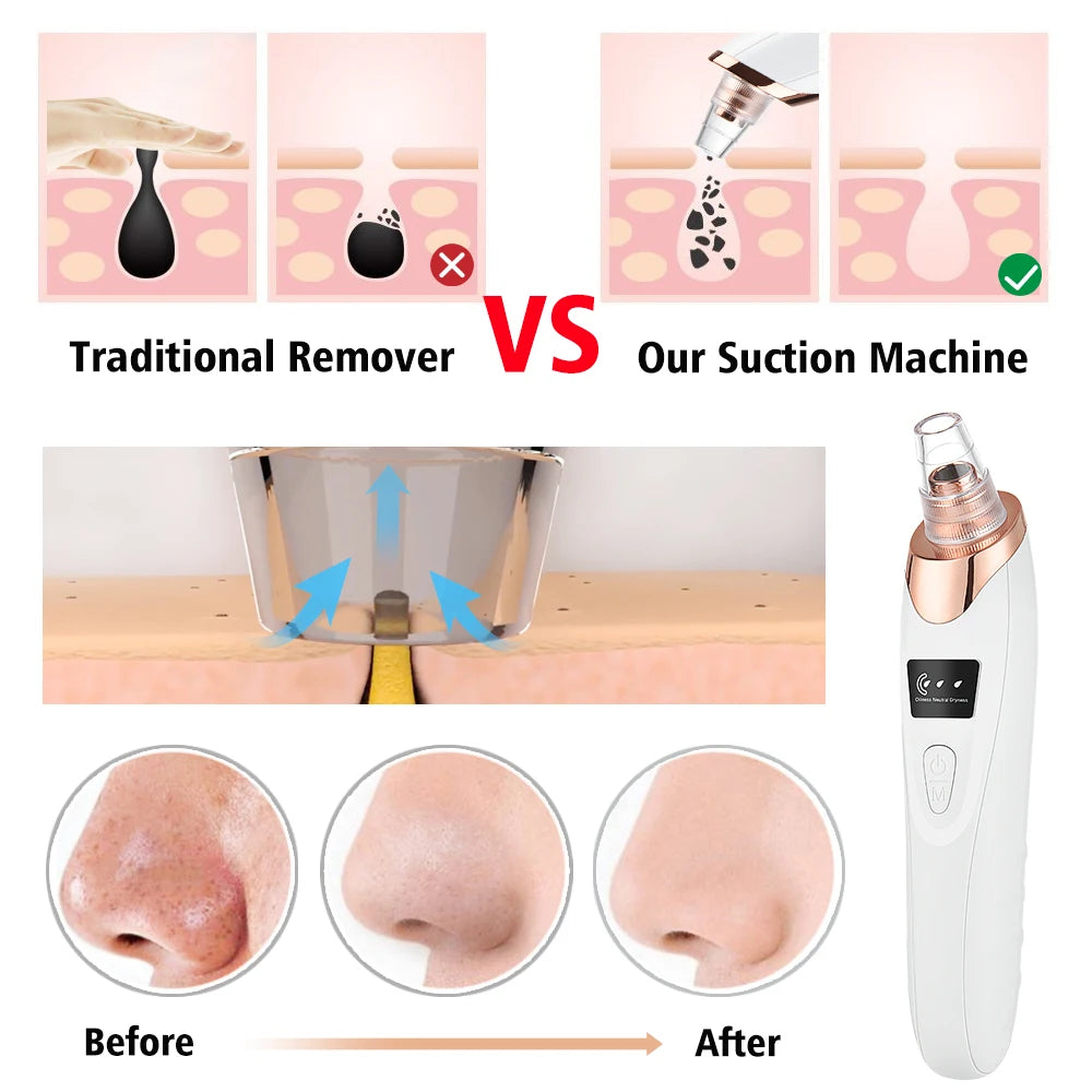 Electric Facial Pore Cleaner with Suction