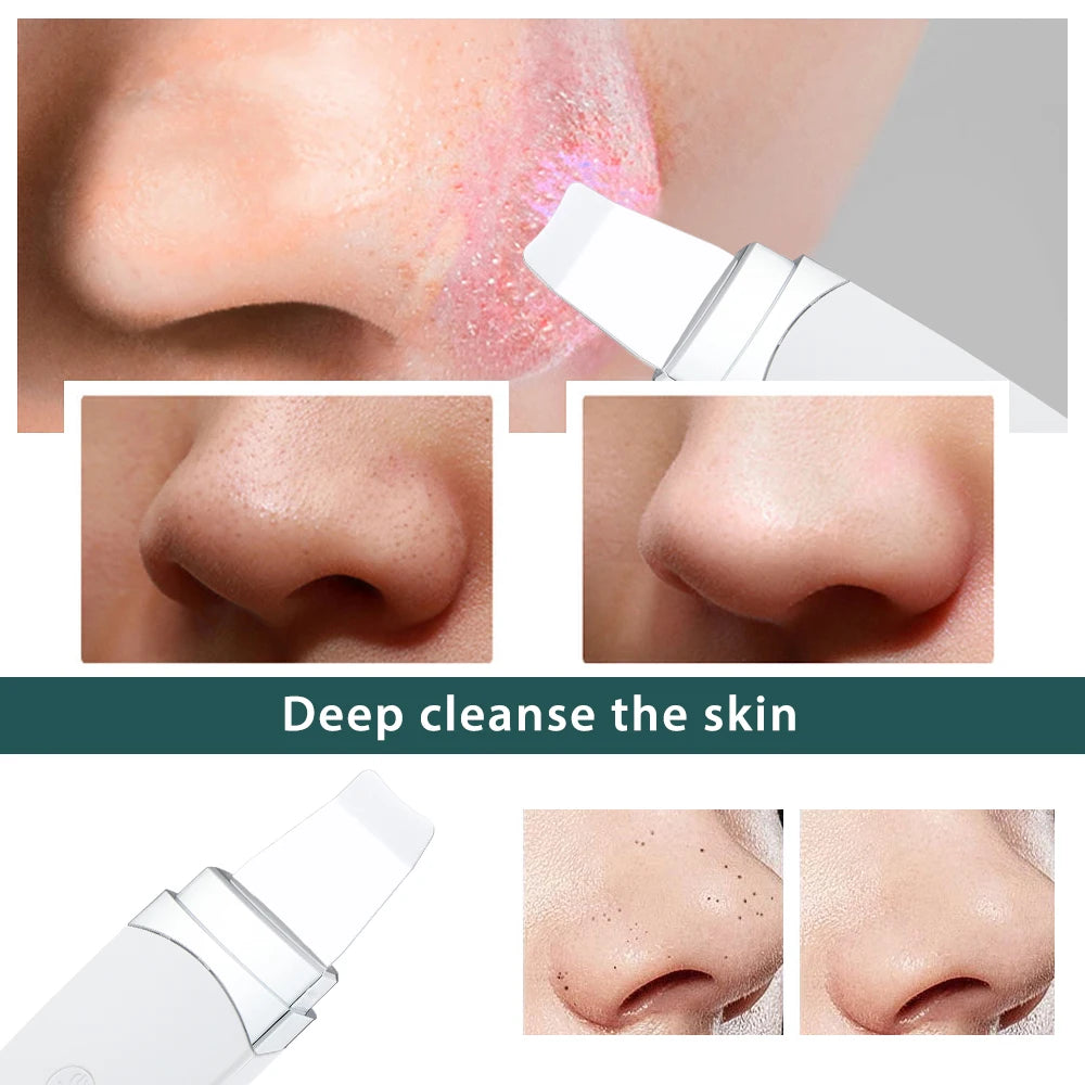 Ultrasonic Skin Cleaner. Blackhead Remover