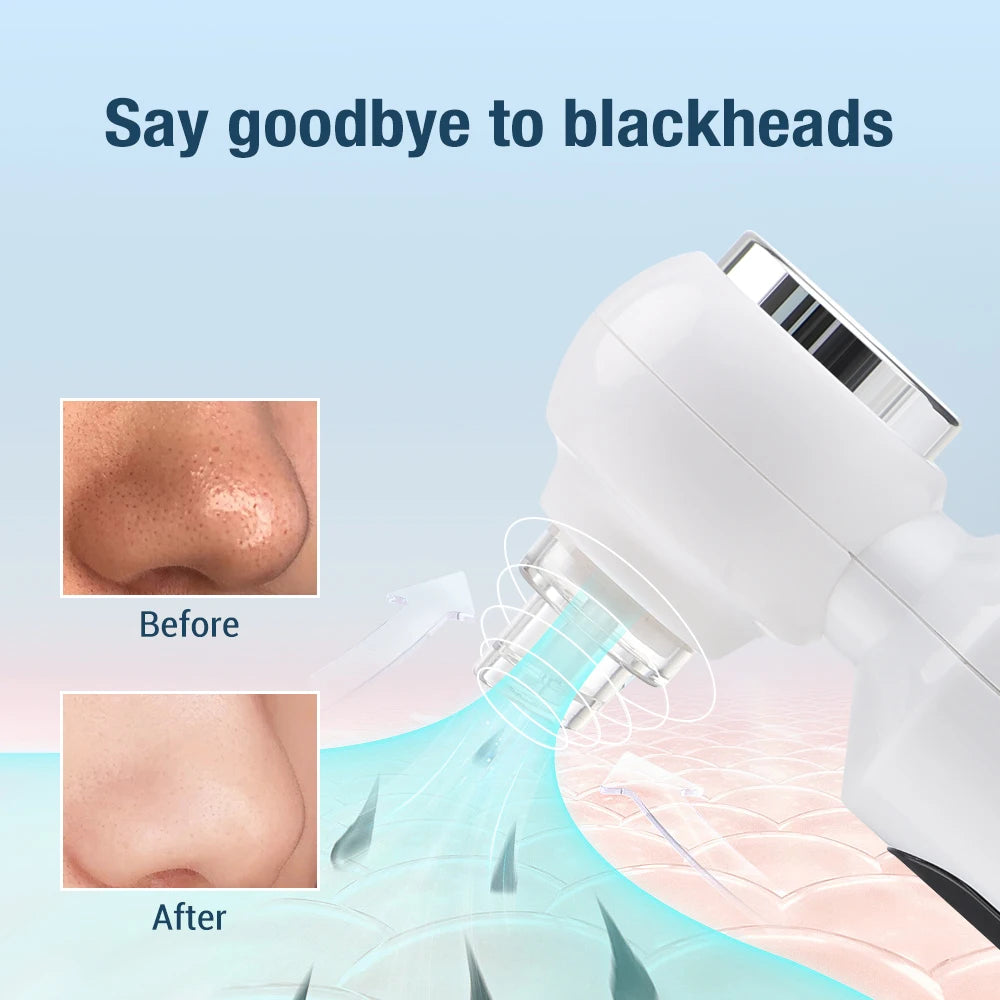 Blackhead Remover with Hot Compress and Blue Light Sterilization